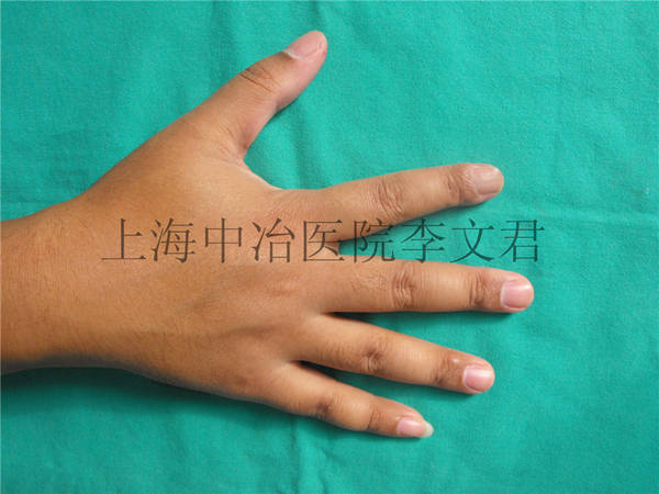 手指术后十月随访