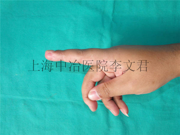 手指术后十月随访