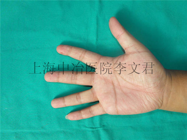 手指术后十月随访