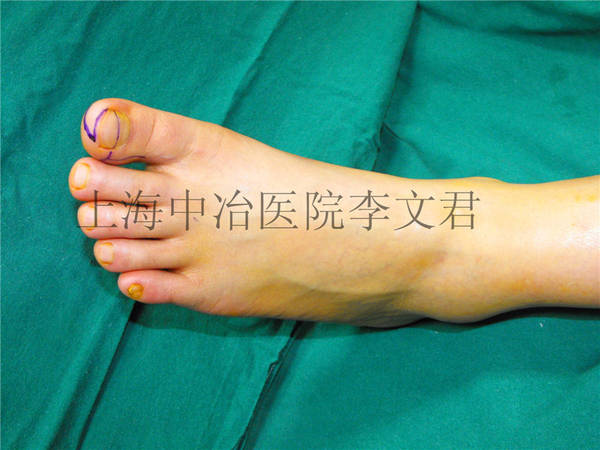 足部设计