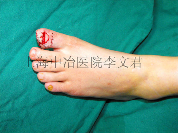 足部修复