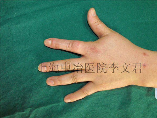 手指术后6月随访