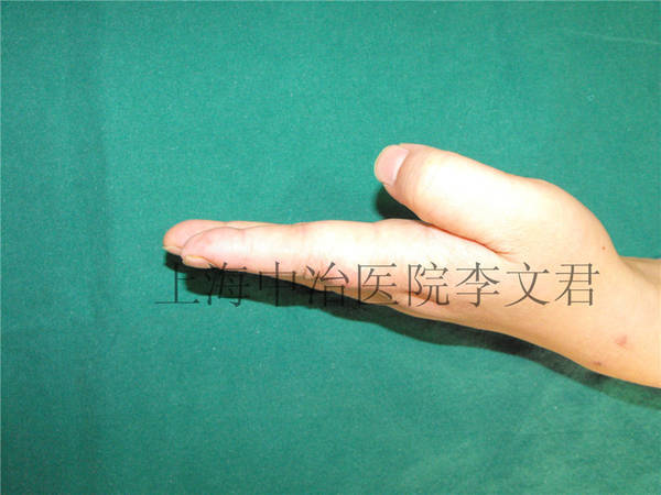 手指术后6月随访