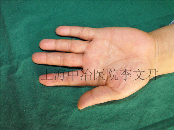 手指术后6月随访