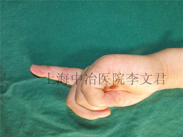 手指术后6月随访