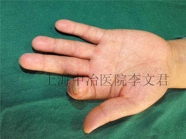 手指术后6月随访