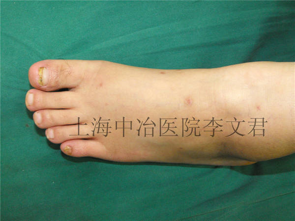 足部术后6月随访