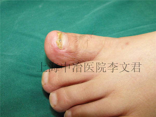 足部术后6月随访