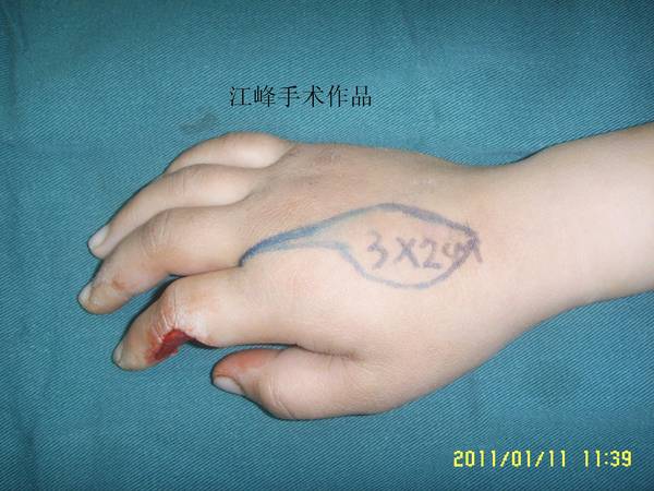 皮瓣设计