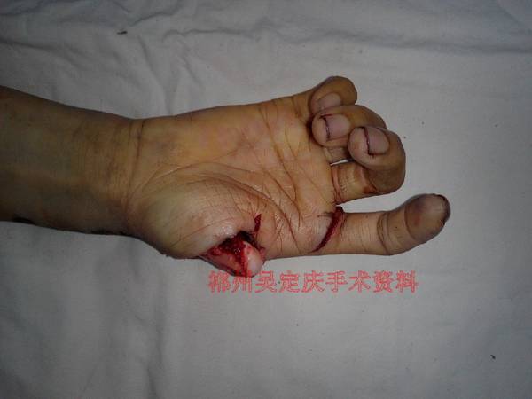 撕脱离断伤 (2).jpeg
