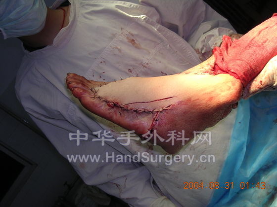 左足大面积皮肤毁损复合组织瓣修复术后01.jpg
