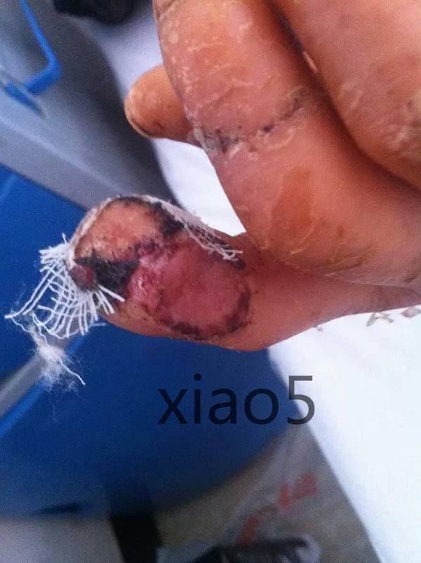 远指间关节皮瓣88_看图王.jpg