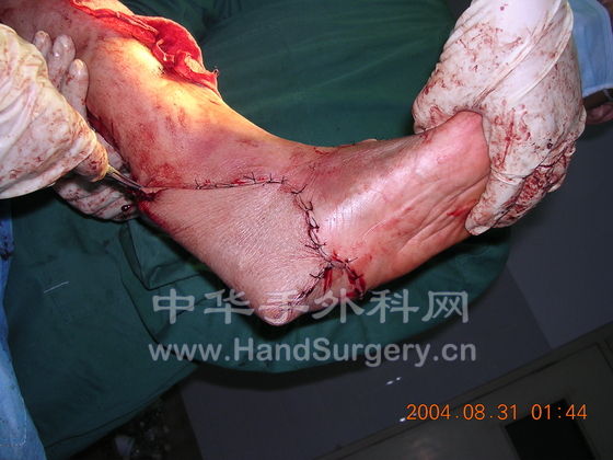 左足大面积皮肤毁损复合组织瓣修复术后02.jpg