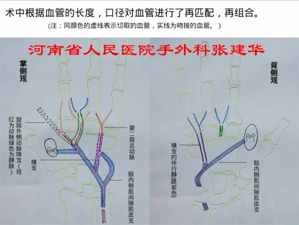 血管吻接示意图