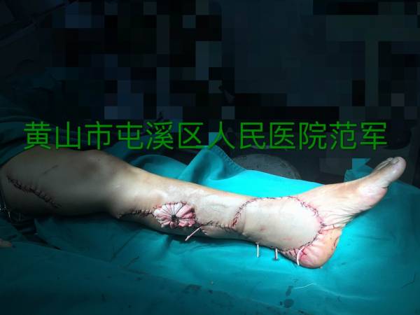 术毕即刻