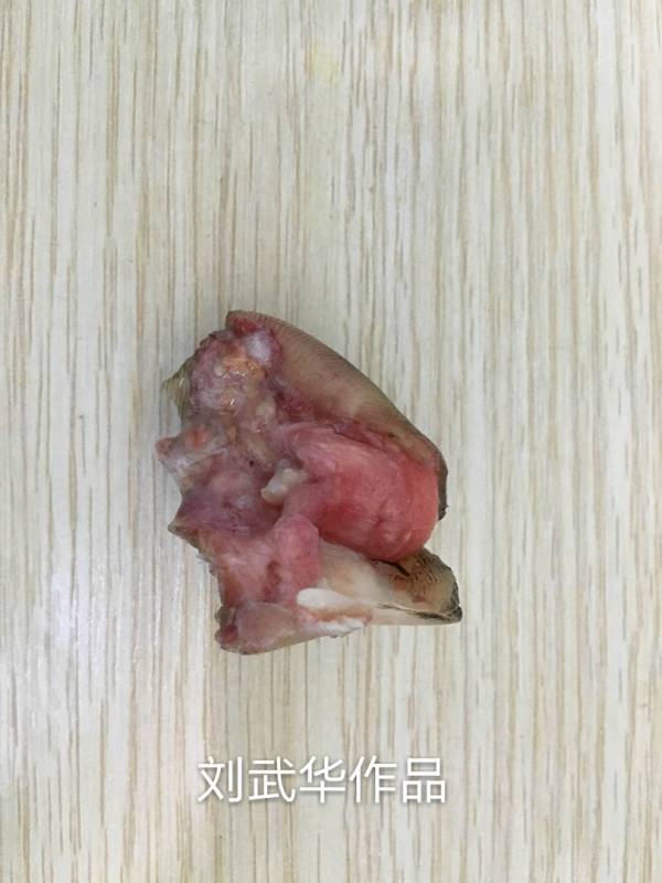 离断拇指情况