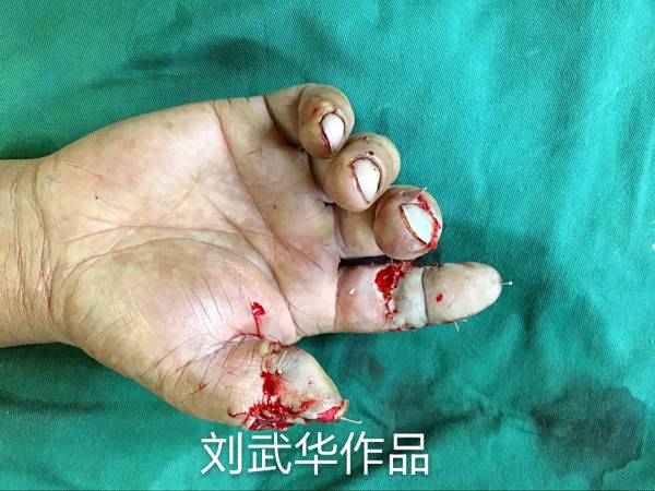 术后即刻