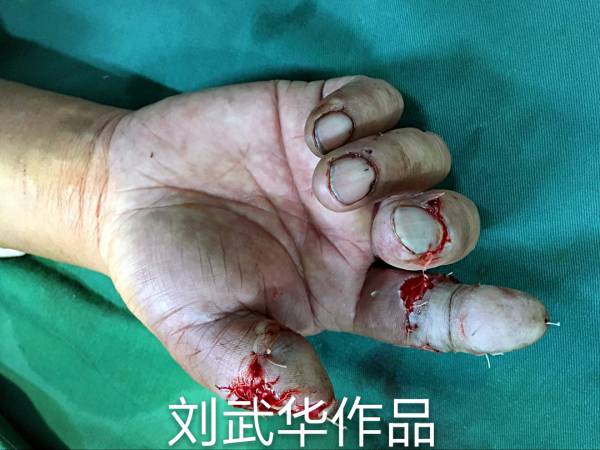 术后即刻