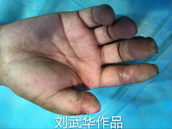 术后三个月