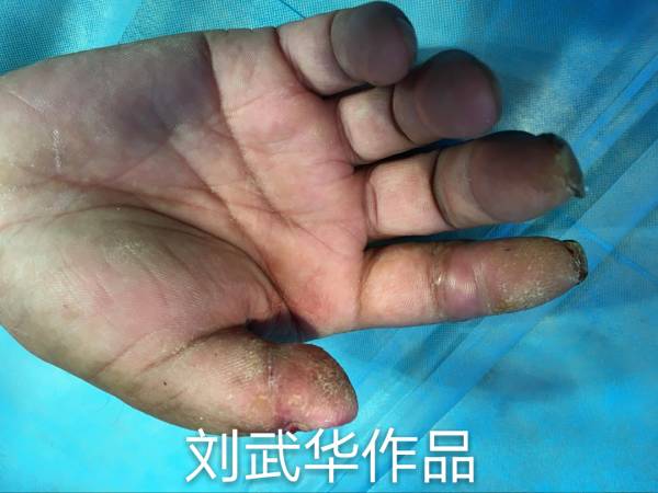 术后三个月